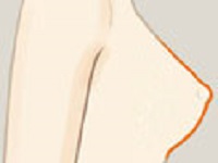 乳头整形