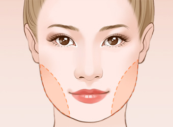 面部苹果肌填充需要几支玻尿酸