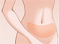 腰腹部吸脂